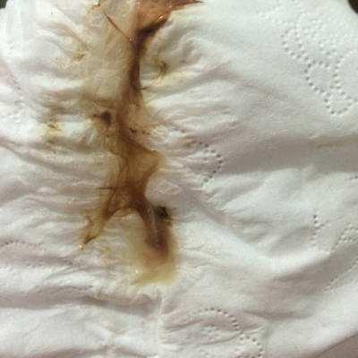 孕期nt过了却有褐色分泌物可能是出现了流产或者是胎停